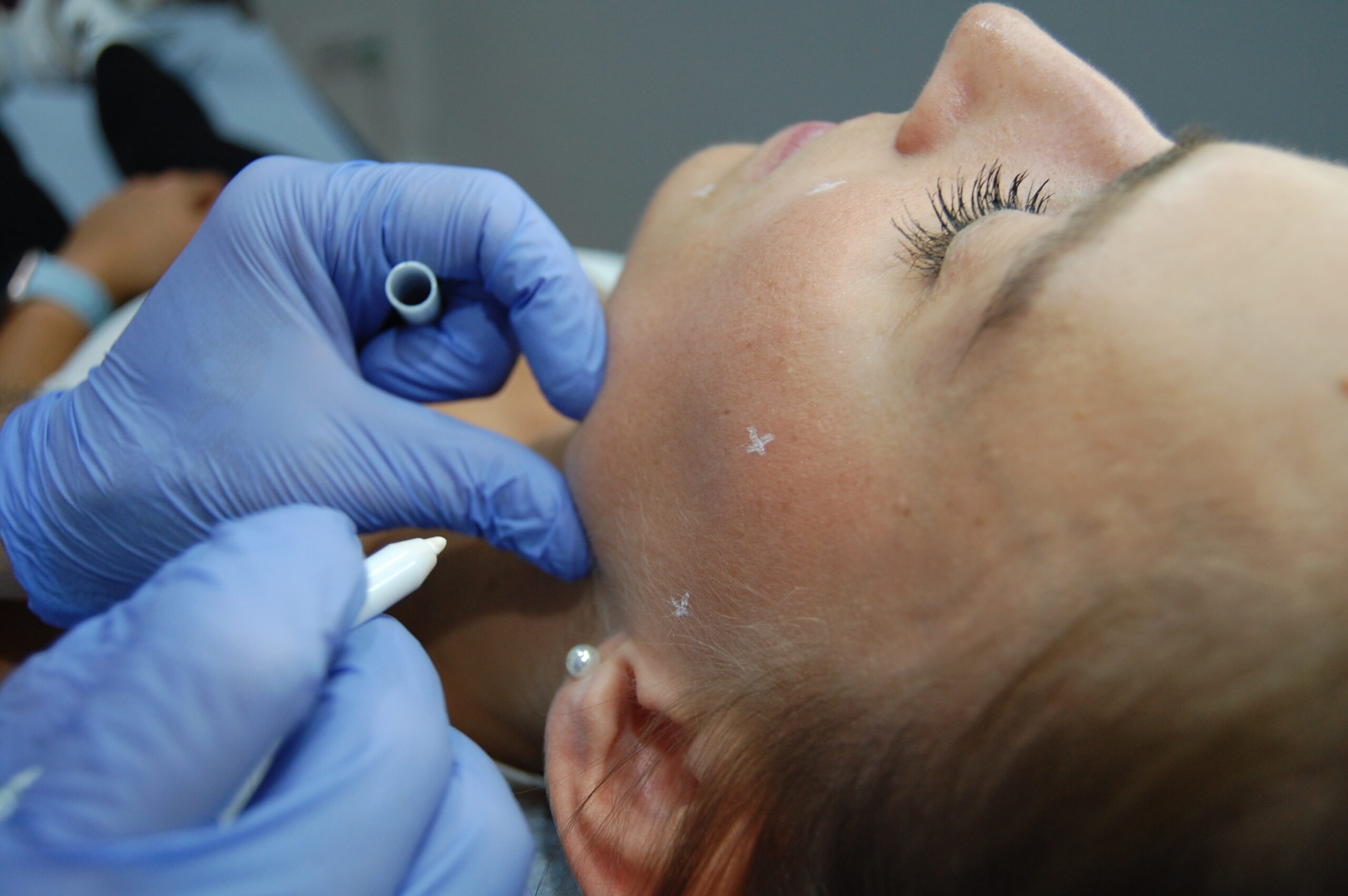 Profhilo treatment Wandsworth