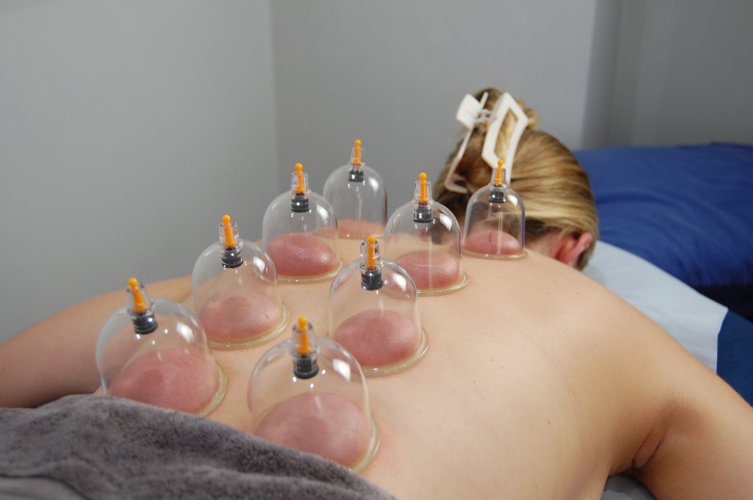 Cupping Wandsworth