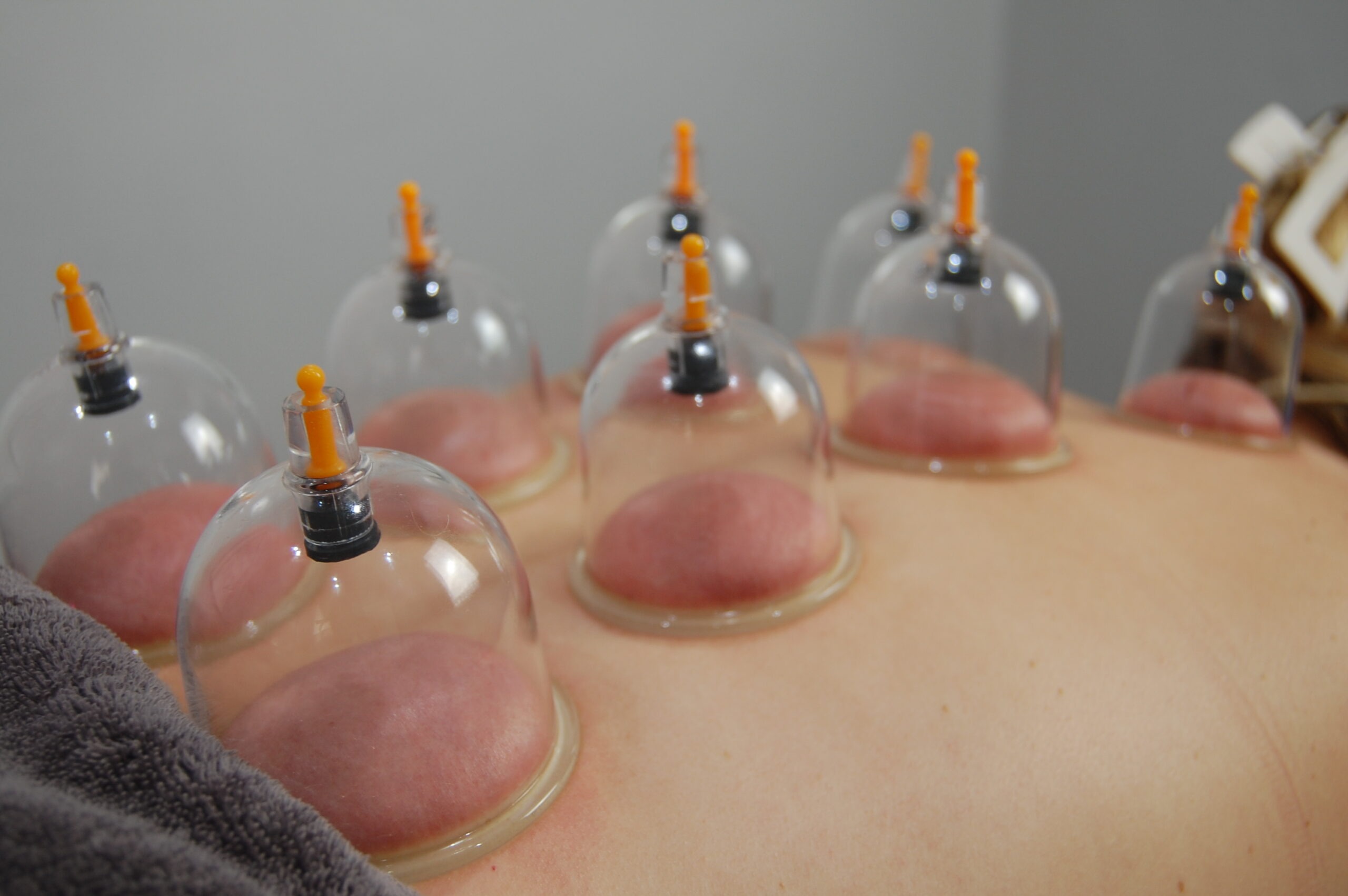 Cupping treatment Wandsworth SW18