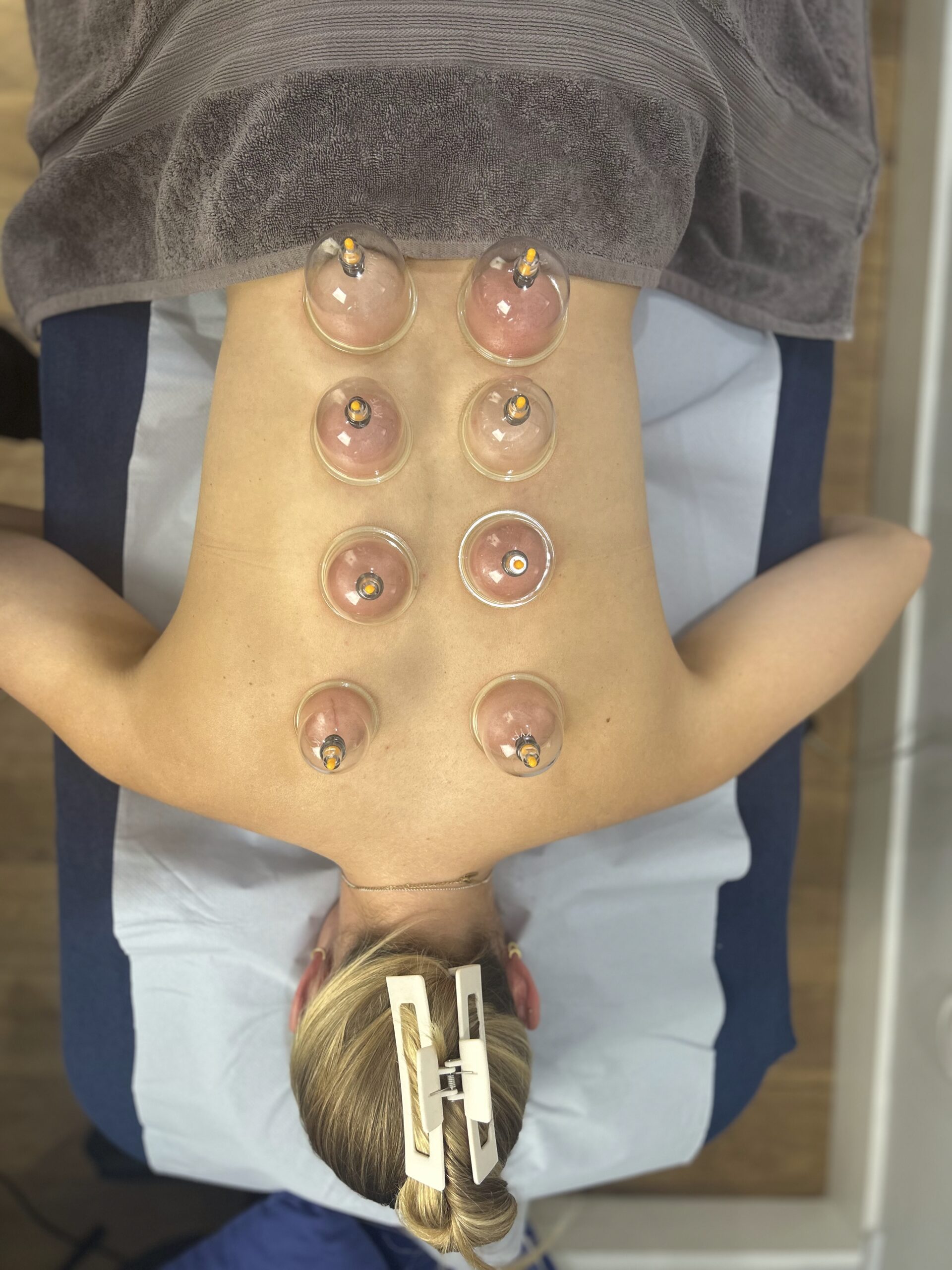Cupping treatment Wandsworth